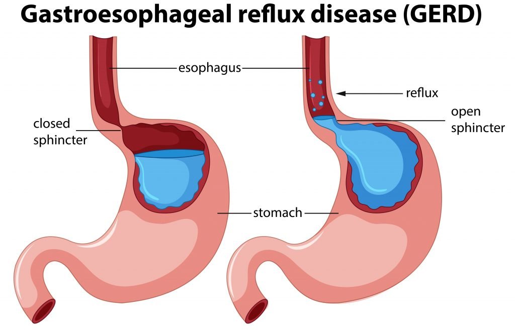 How To Relieve Gerd Chest Pain Fast Reddit